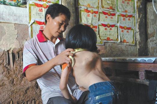 有嚴重脊椎畸形及胸腔隆突病的李文霞。