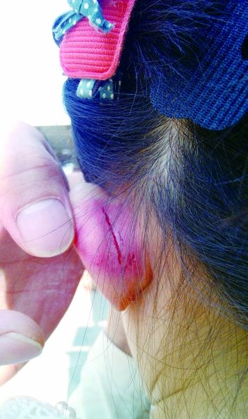 　　女童的耳朵被老師揪裂。圖片由女童家人提供