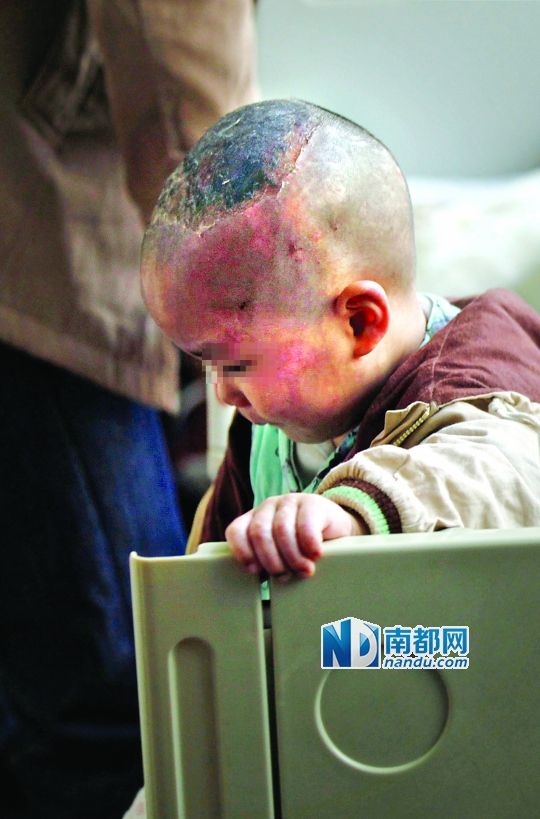 1月8日下午，小寶頭上和臉上都是傷痕。