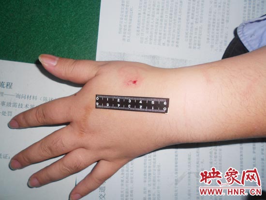 為幫助無證駕駛的朋友逃避處罰，新鄉(xiāng)的王某竟對(duì)執(zhí)勤民警大打出手，還將一名民警的手臂咬傷