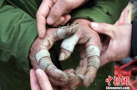 圖為由于常年拾荒，老人雙手布滿傷口。周小云 攝