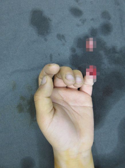 嚇哭！6歲男孩被夾斷手指 罪魁禍?zhǔn)拙故切７? oldsrc=
