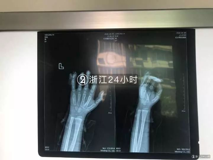 嚇哭！6歲男孩被夾斷手指 罪魁禍?zhǔn)拙故切７? oldsrc=