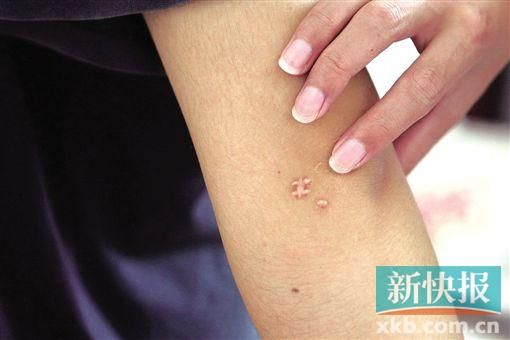 取出針后李星兒手臂留下了傷口。新快報(bào)記者 張國(guó)鋒/攝