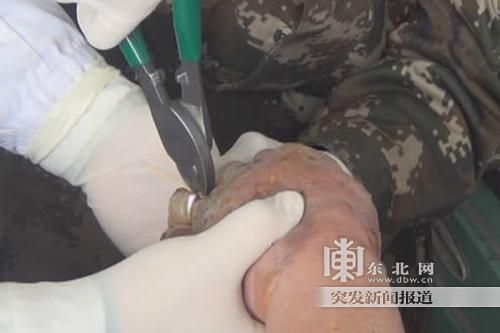 正在拆除戒指。